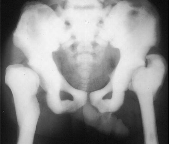 Osteopetrosis