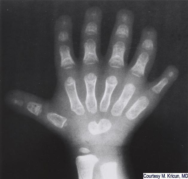 polydactyly, ellis-van creveld