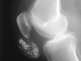 Pre-patellar bursitis-Housemaids knee