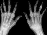 Rheumatoid arthritis-both hands