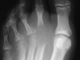 Septic arthritis-foot