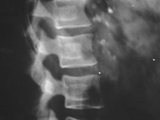 Thoratrast-spine and nodes