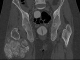 Tumoral calcinosis-hip