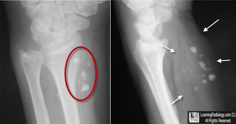 Hemangioma