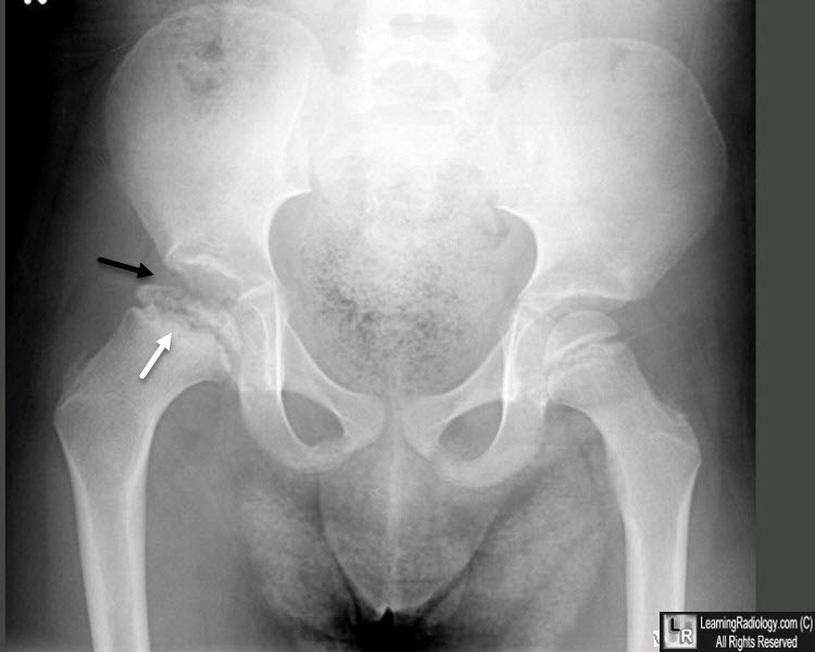 slipped capital femoral epiphysis vs legg calve perthes disease