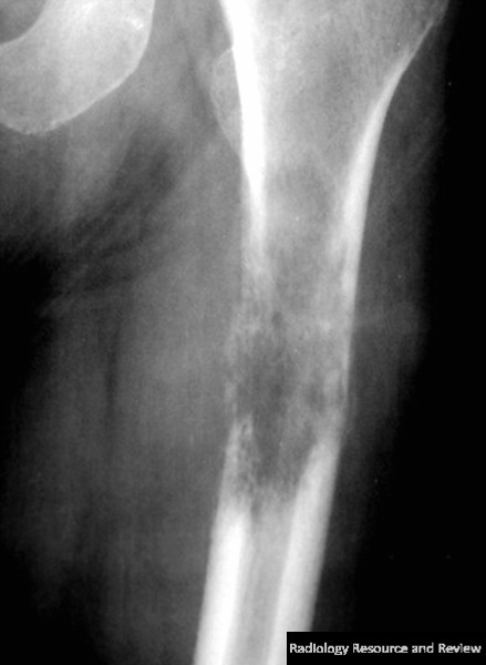 Pathologic Fracture of Femur