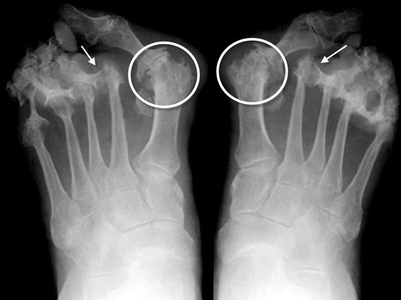 Rheumatoid arthritis radiology foot, Betegség megnevezésének szinonímái: