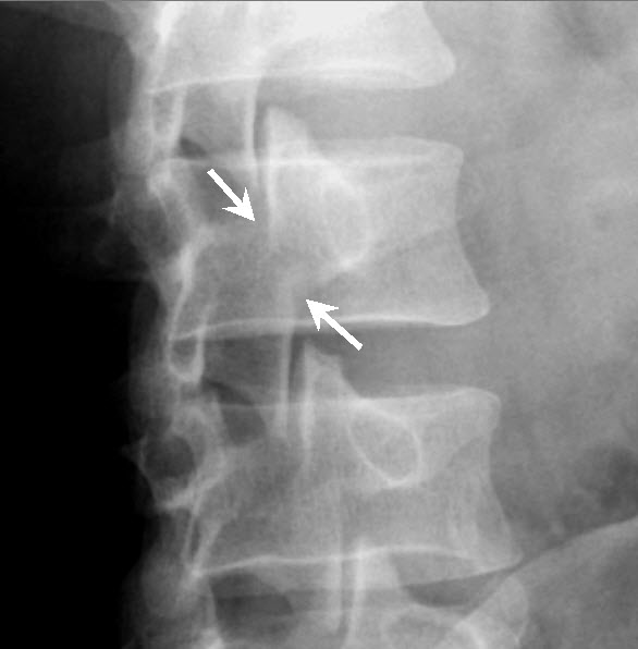 learning-radiology-spondylolysis