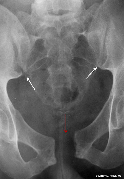 sprung pelvis, open book pelvis