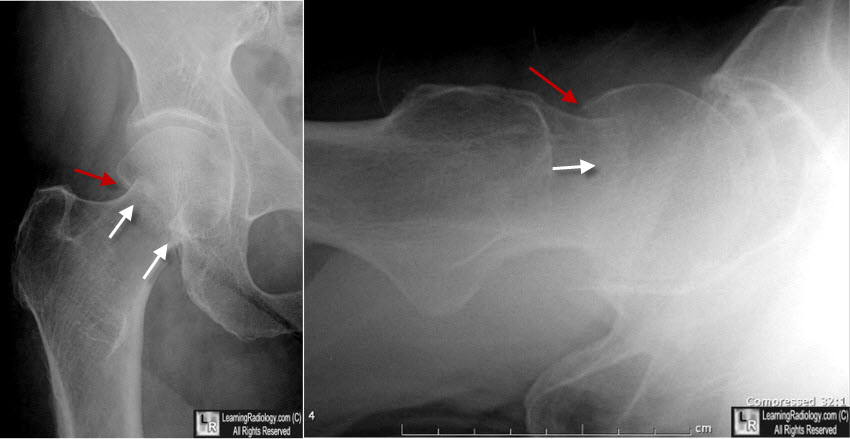 displaced right femoral neck fracture