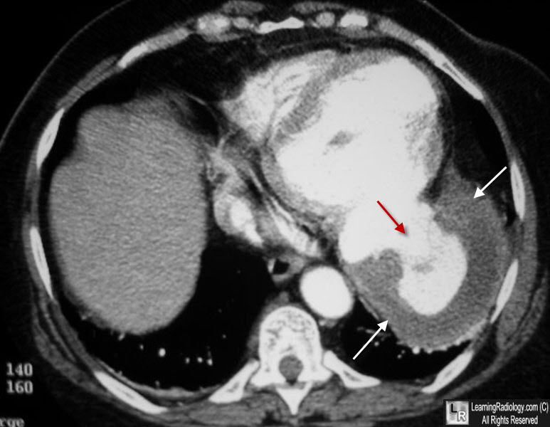 Learning Radiology Ventricular Aneurysm Chest Left Ventricle