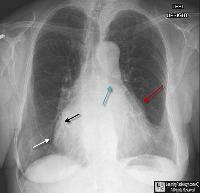 mitral stenosis, ms