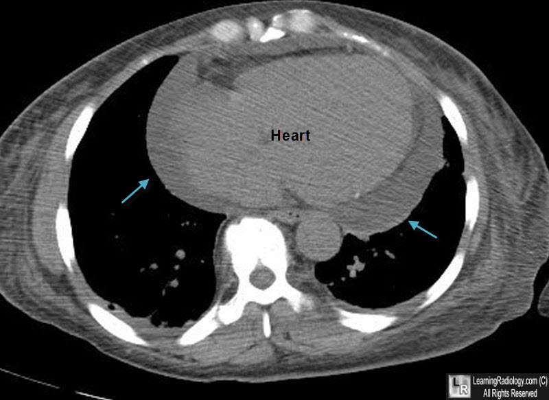 pericardial effusion x ray