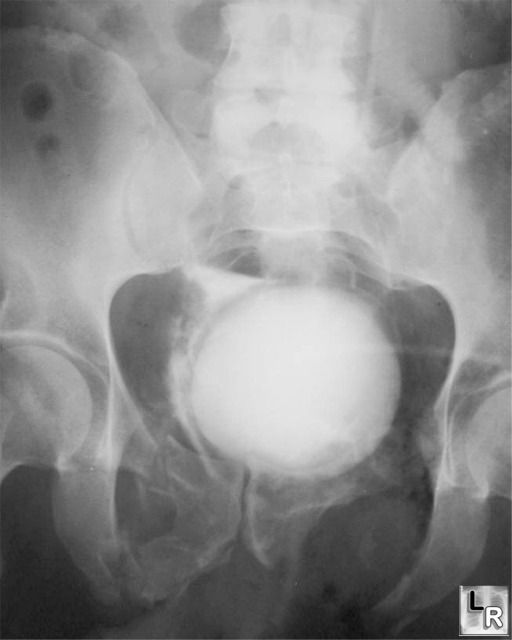 Extraperitoneal bladder rupture