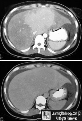 Budd-Chiari Syn