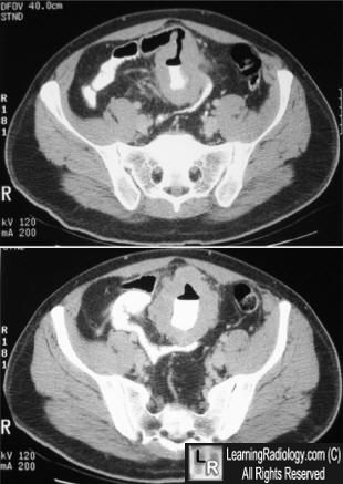 Lymphoma of small bowel