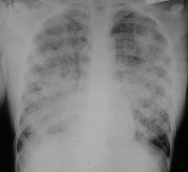 Learningradiology Acute Respiratory Distress Syndrome Adult Ards