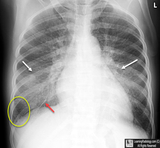 pulmonary edema chf chest x ray