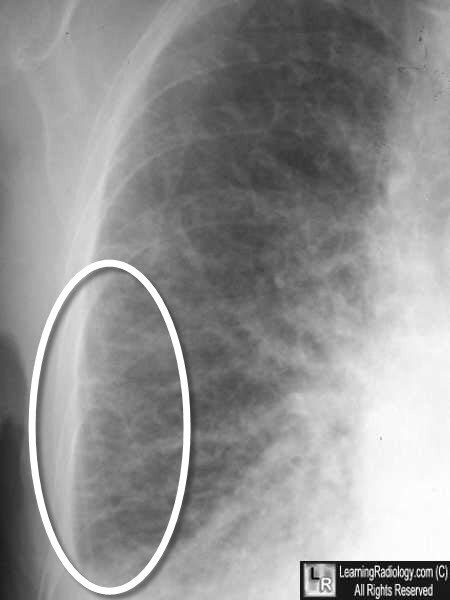 pulmonary edema chf chest x ray