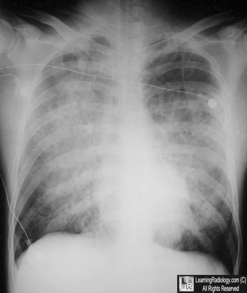 pulmonary edema chest x ray