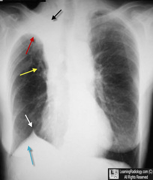 right upper lobe atelectasis, rul
