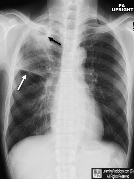 Tuberculosis, cavitary