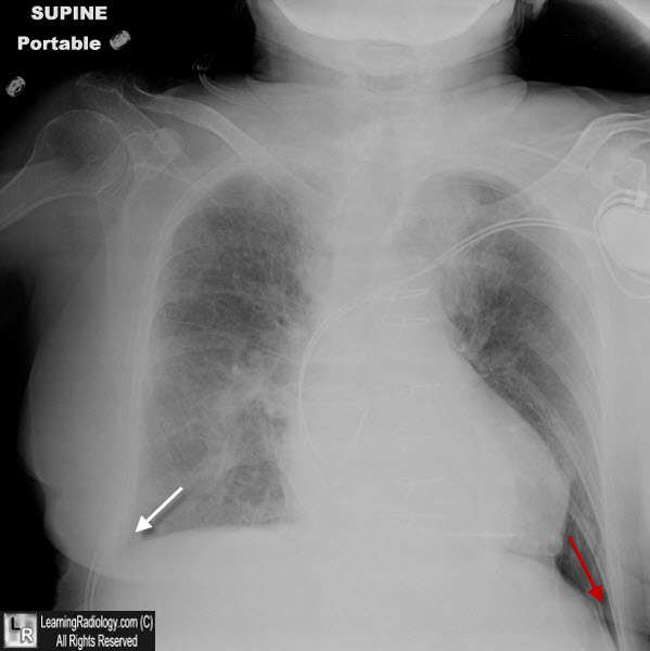 Left pneumothorax-deep sulcus sign