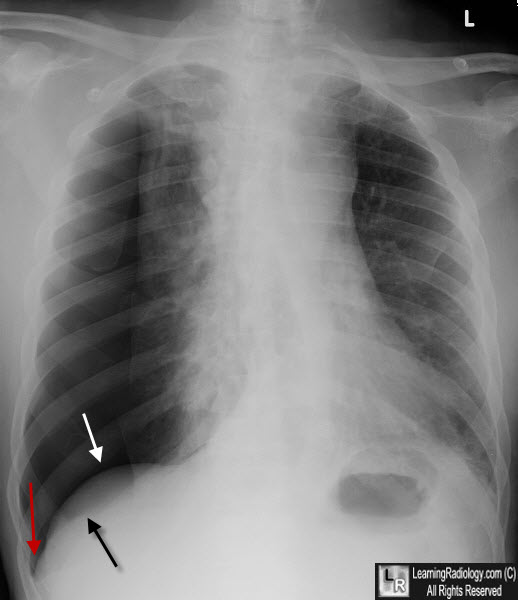 Double Diaphragm Sign of Pneumothorax