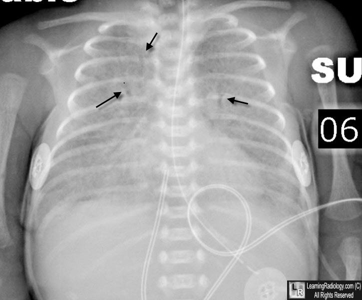 respiratory distress syndrome x ray