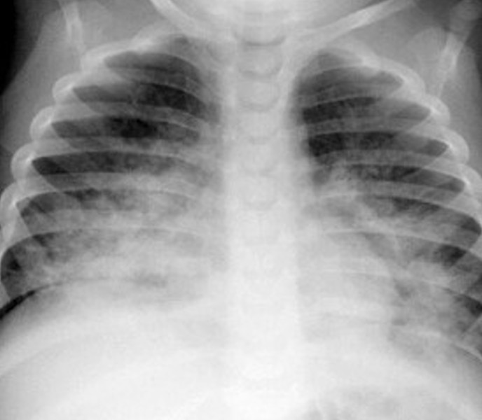 Hydrocarbon Aspiration/Pneumonitis