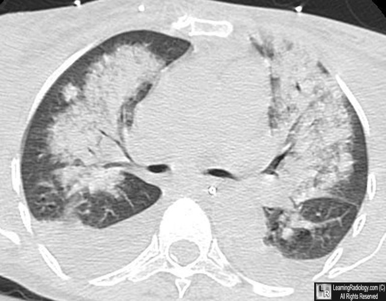 pulmonary edema lung sounds