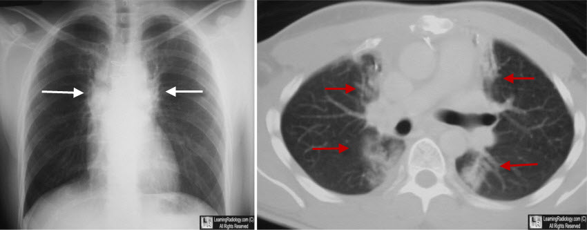 Radiation fibrosis