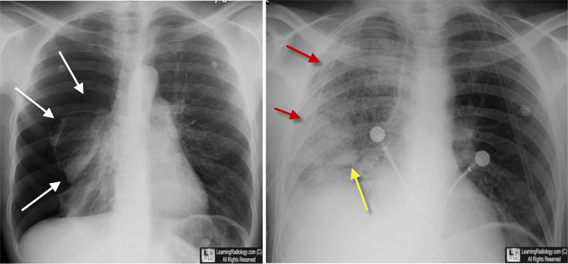 reexpansion pulmonary edema