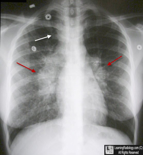 sarcoid lung