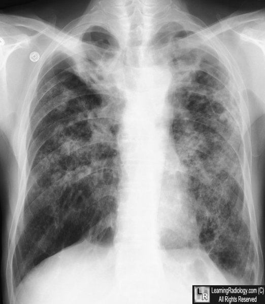 tuberculosis