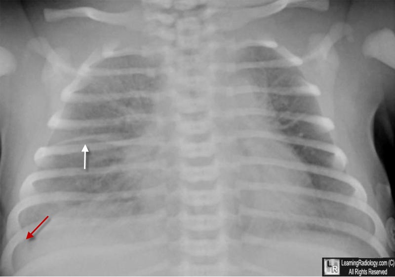 The Transient Tachypnea Of Newborn