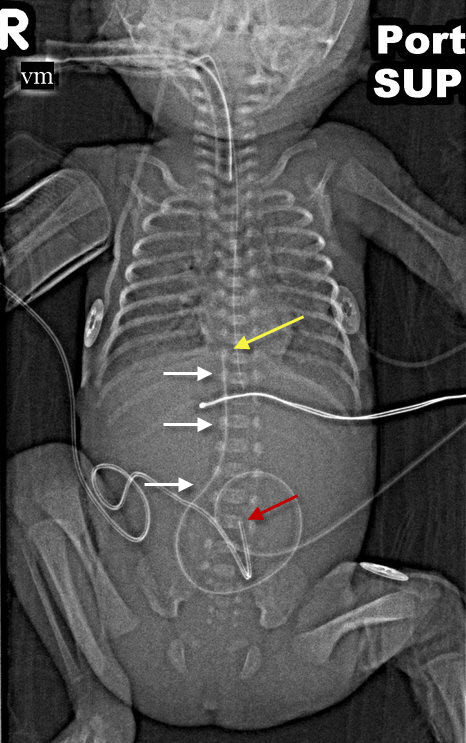 Learning Radiology Umbilical Venous Catheter In Left Ventricle