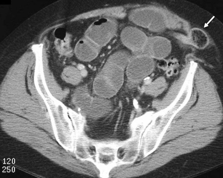 Incarcerated femoral hernia with small bowel obstruction, Radiology Case