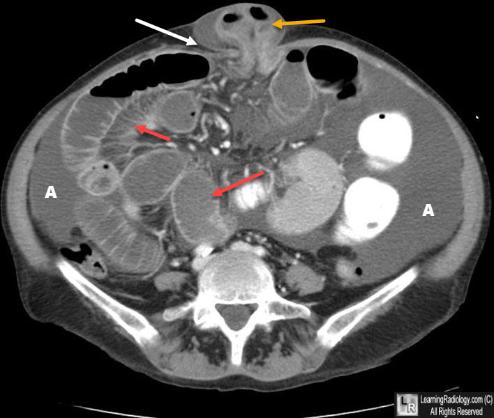 LearningRadiology - Abdominal and Pelvic hernia