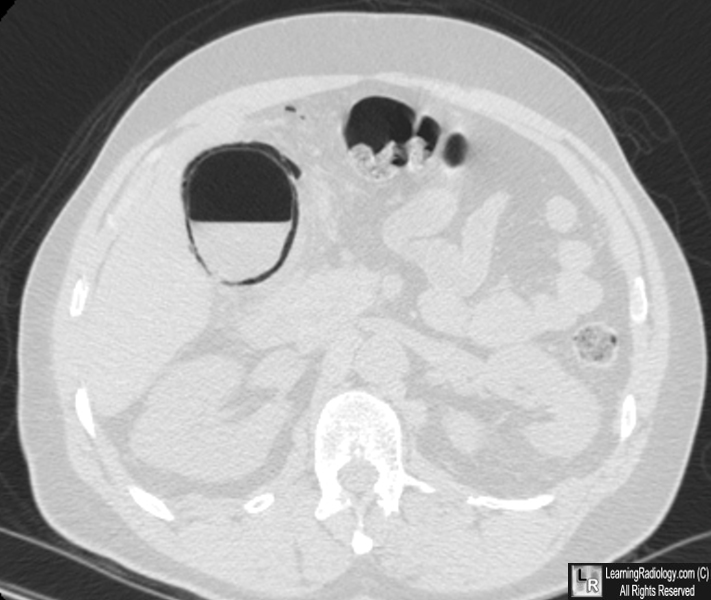 cholecystitis x ray