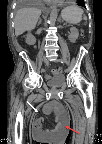 Incarcerated femoral hernia with small bowel obstruction, Radiology Case