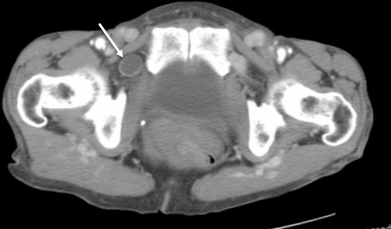 Obturator hernia