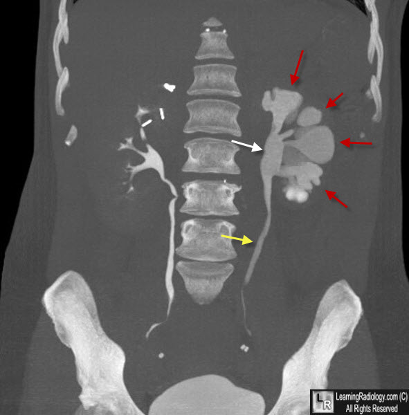 Congenital Megacalyces