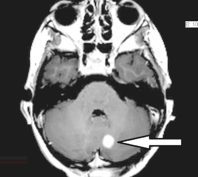 Cerebellar Pilocytic Astrocytoma