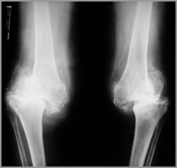 rheumatoid arthritis radiology knee)
