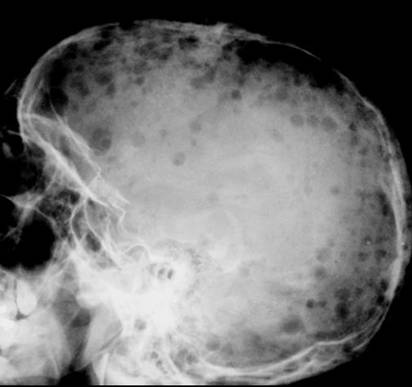 Learningradiology-bone Tumors