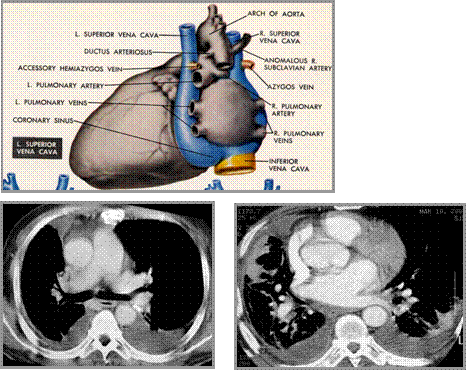 Learningradiology Diseases Of The Great Vessels