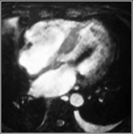 LearningRadiolgy.comn- Valvular Lesions Of The Heart,pulmonic,tricuspid ...