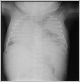 Learningradiology.com - Diseases Of The Diaphragm