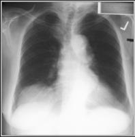 LearningRadiology.com - Diseases Of The Diaphragm